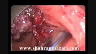 برداشتن پولیپ بزرگ کولون سیگمویید بطریقه جراحی هیبرید کلونوسکوپیک-اینترالومینال بروش TEO