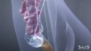 ایلئوستومی