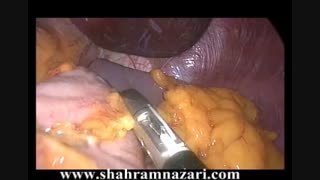 مراحل عمل جراحی اسلیو گاسترکتومی لاپاروسکوپیک