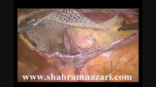 لاپاروسکوپی یک فتق  کشاله ران در خانم جوان