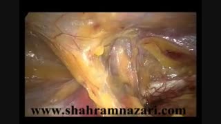 لیپوم کورد در جراحی فتق مغبنی