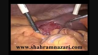 کله‌سیستیت حاد