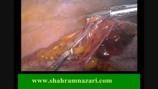 جراحی لاپاروسکوپیک تومور روده بزرگ(ترمیم خارج شکمی)