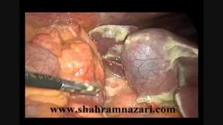 زخم اثنی عشر یا دوازدهه سوراخ شده