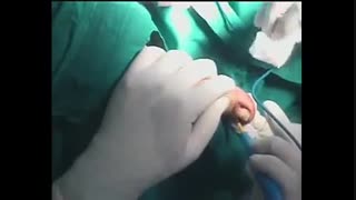 جراحی کشیدن ناخن شست پا...