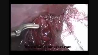 آشالازی، کاردیومیوتومی هلر