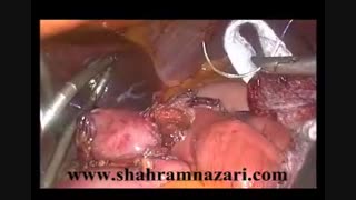 گاستریک مینی بای پاس