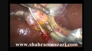 فایل صوتی تصویری: مراحل عمل کله سیستکتومی لاپاروسکوپیک