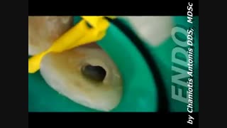 درمان ریشه دندان