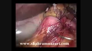 گاسترکتومی