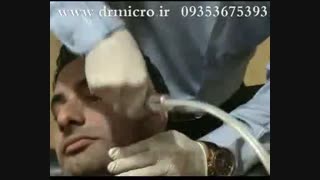 microdermabrasion