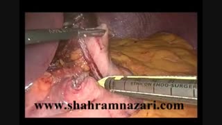 مینی گاستریک بای پاس معده/ اسلیو لوپ بای پاس معده در چاقی