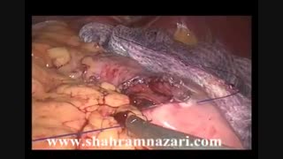 رزکسیون لاپاروسکوپیک  دیستال گاسترکتومی در تومور GIST آنتر معده