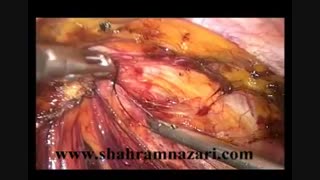 رینگ پلاستی در ترمیم فتق مغبنی (اینگوینال) توسط دکتر شهرام نظری