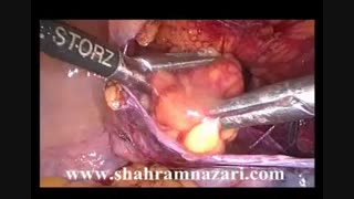 ترمیم هرنی عود کرده گیر کرده کشاله ران  (اینکارسره) توسط دکتر شهرام نظری