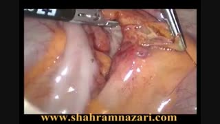 آبسه آپاندیس توسط دکتر شهرام نظری اینسایزینگ