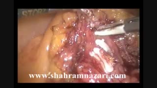کولکتومی لاپاروسکوپیک سمت راست Laparoscopic Right Hemicolectomy توسط دکتر شهرام نظری