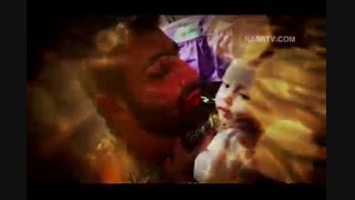 برای دلتنگی سلما ... جراحی پف زیر چشم