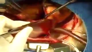 عمل پیوند قلب / Heart Transplant Surgery