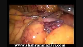 سیگموییدکتومی لاپاروسکوپیک