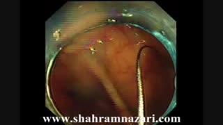 پولیپکتومی راست روده با کلونوسکوپ