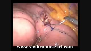 توتال گاسترکتومی لاپاروسکوپیک