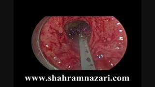 جراحی آندوسکوپیک بروشTEO