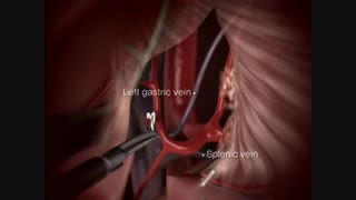 دیستال گاسترکتومی