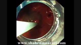 پولیپکتومی آندوسکوپی معده توسط دکتر شهرام نظری دندان شیری