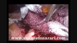 خارج کردن بالن معده و اسلیو گاسترکتومی لاپاروسکوپیک