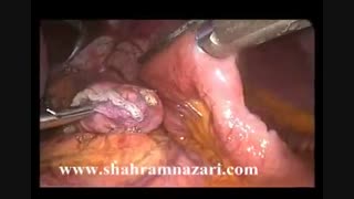 مینی بای پاس معده بدنبال اسلیو گاسترکتومی توسط دکتر شهرام نظری