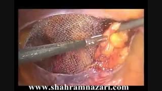 ترمیم لاپاروسکوپیک هرنی مغبنی ( کشاله ران) در زن