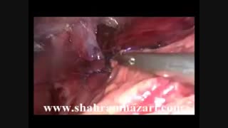 گاستروپلاستی کولیس همراه با فوندوپلیکاسیون نیسن در کوتاهی مری