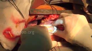 عمل جراحی قلب باز