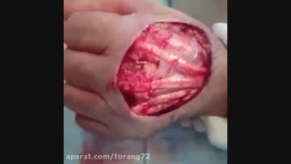 نمایی از تاندون پشت دست