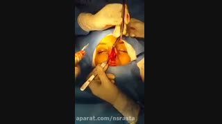 قسمتی کوتاه از عمل جراحی بینی