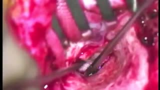 تعمیر پرده گوش