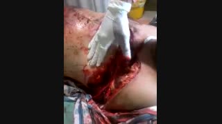 تپش قلب فرد تصادفی