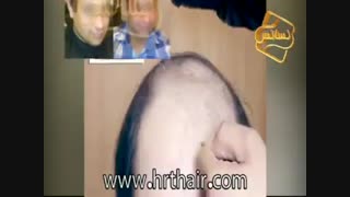 فیلم اجرای ترمیم مو به روش HRT