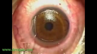 جراحی لیزیک چشم