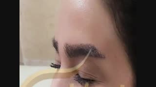 کاشت ابرو طبیعی با روش SUT مرکز کاشت مو رنسانس لیپوساکشن