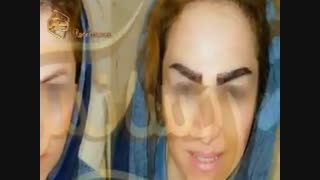 کاشت ابرو طبیعی با روش SUT مرکز کاشت مو رنسانس پیلینگ