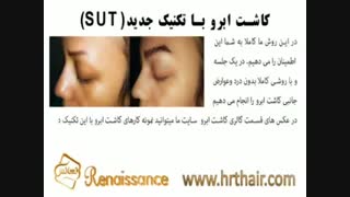 کاشت ابرو طبیعی با روش SUT مرکز کاشت مو رنسانس عصب‌کشی