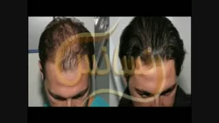 کاشت مو به روشSUT مرکز مو رنسانس