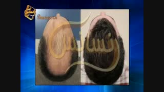 کاشت مو به روشSUT مرکز مو رنسانس
