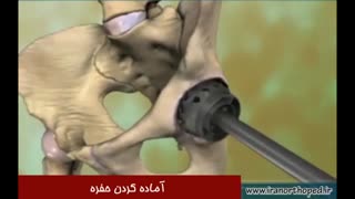 جراحی تعویض مفصل لگن و ران