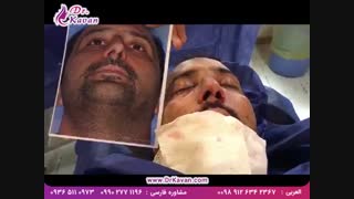 عمل انحراف و زیبایی بینی توسط دکتر کاوان