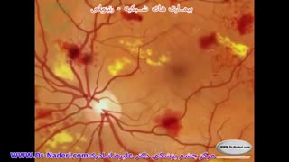 درگیری شبکیه ناشی ازدیابت-مرکزچشم پزشکی دکترعلیرضا نادری
