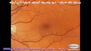 نوع شدید اثر دیابت بر شبکیه - مرکزچشم پزشکی دکترعلیرضا نادری