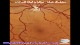 تورم ماکولا در دیابت - مرکزچشم پزشکی دکتر علیرضا علیرضا نادری ارتودنسی